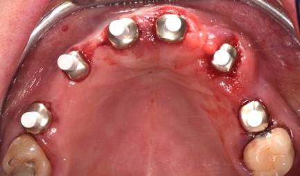 Monconi provvisori in PEEK inseriti