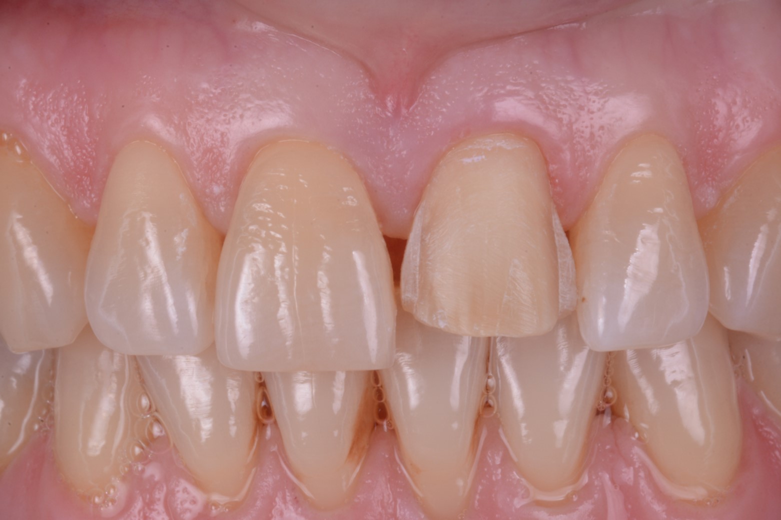 preparazione icisivo