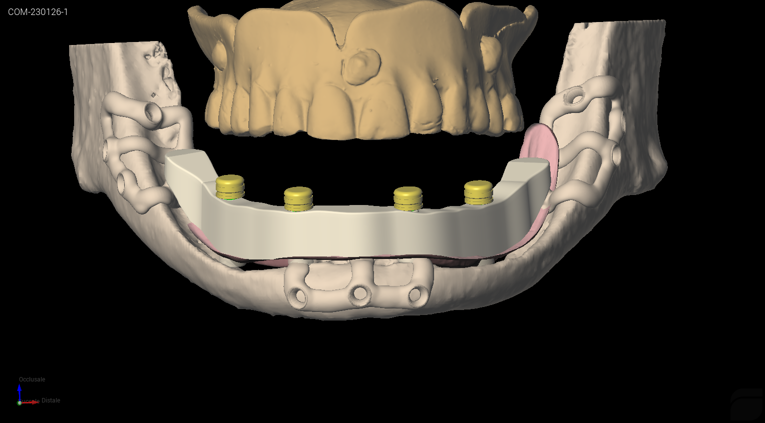 Posizionamento digitale attacchi a pallina