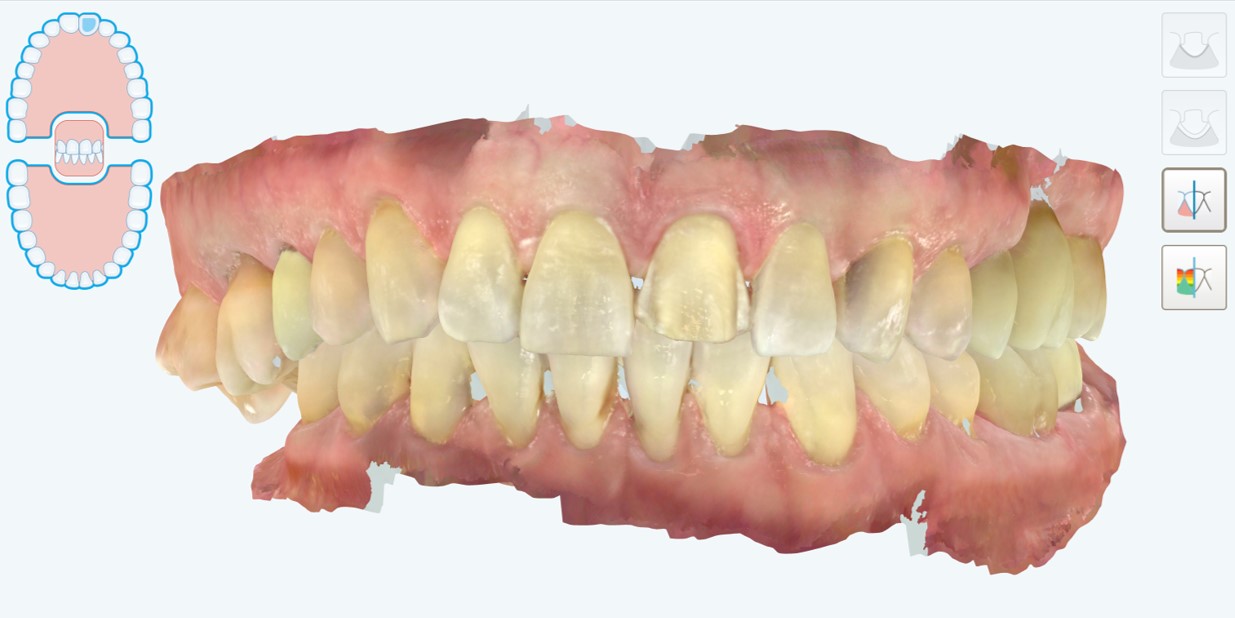 scansione intraorale iTero