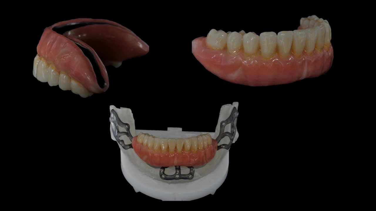 Controbarra ibrida titanio/composito