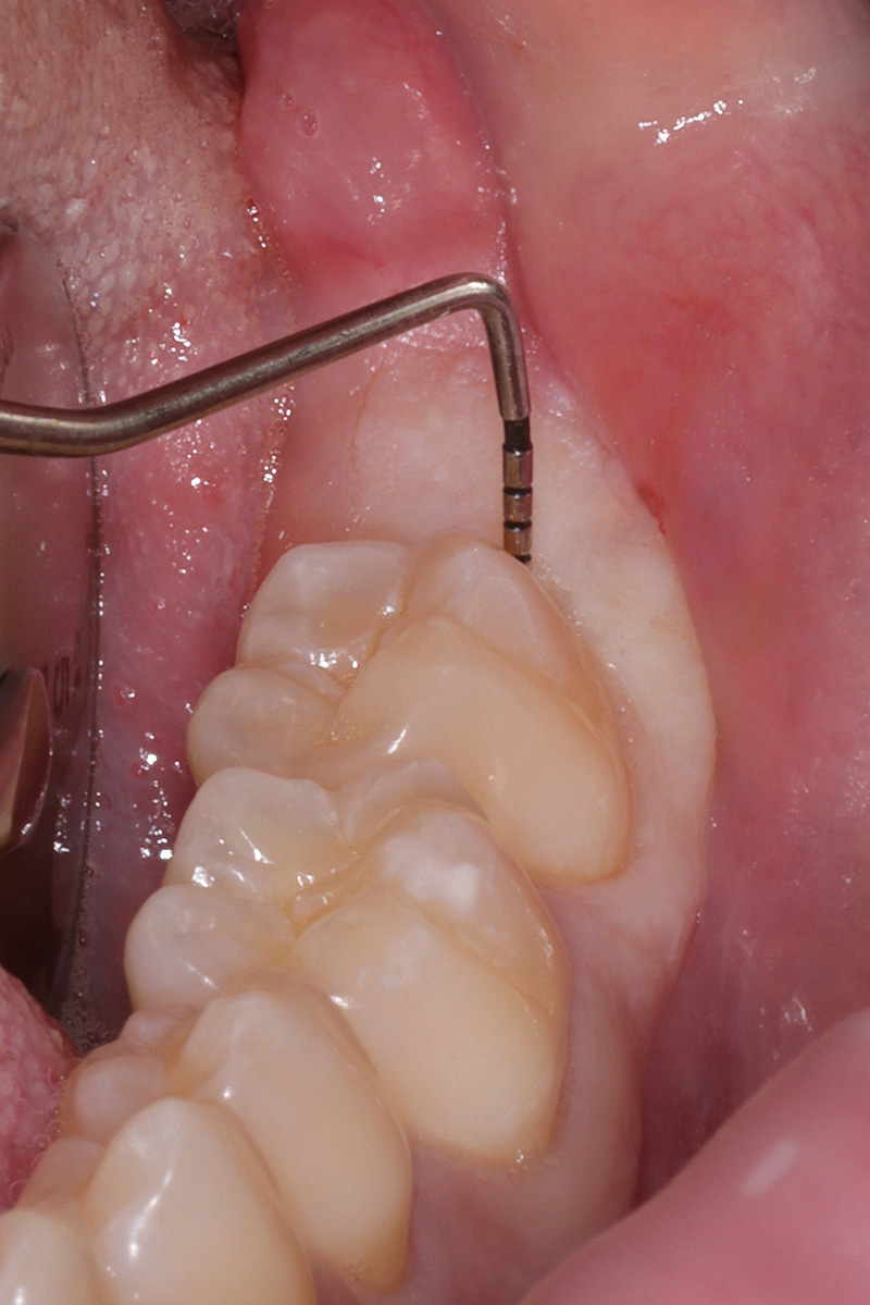 Situazione clinica iniziale con sondaggio di circa10 mm