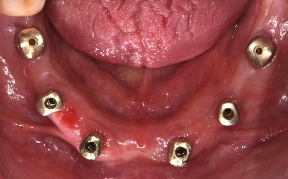 Profili di emergenza ideali disegnati dagli iPhysio 2