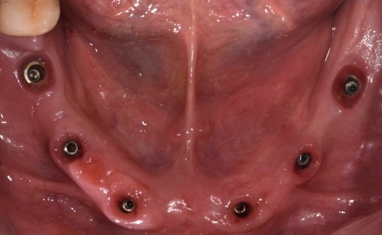 Profili di emergenza ideali disegnati dagli iPhysio 3