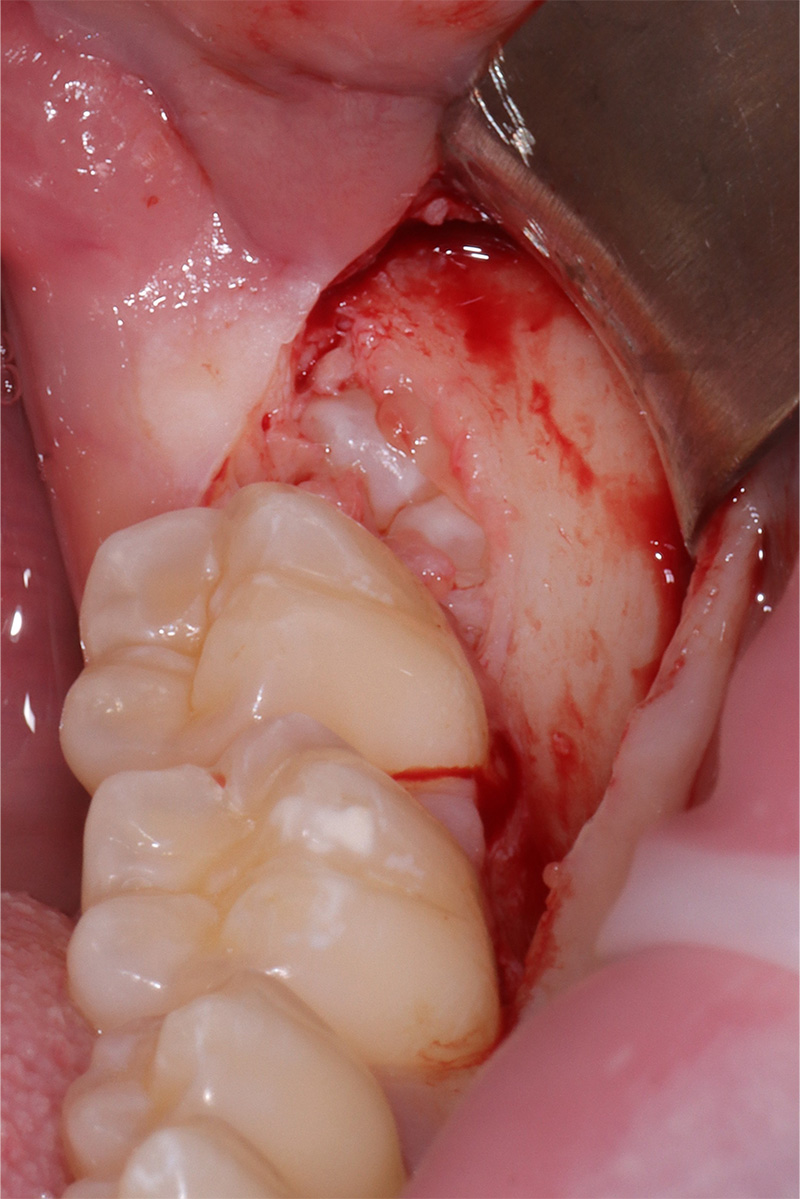 Lembo a busta elevato