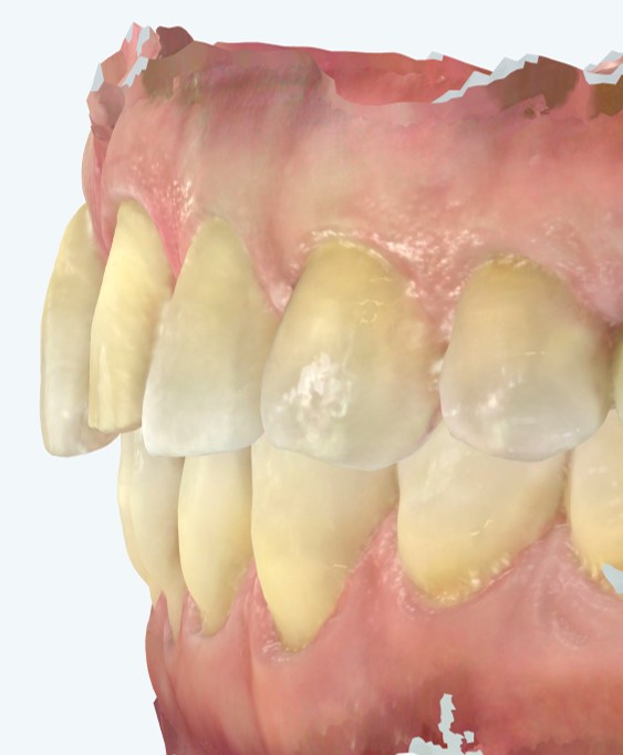 visione laterale della preparazione