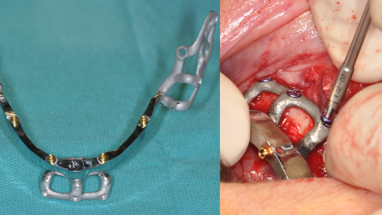 Posizionamento delle viti autofilettanti