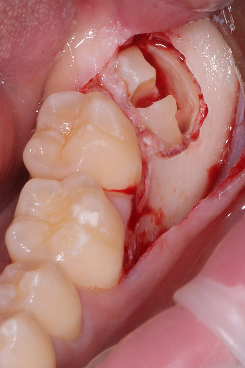 Osteotomia e odontotomia a T