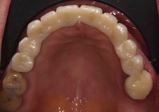 Il restauro definitivo alla consegna 3