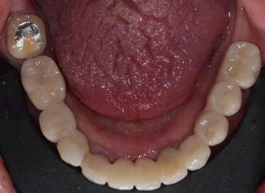 Il restauro definitivo alla consegna 4