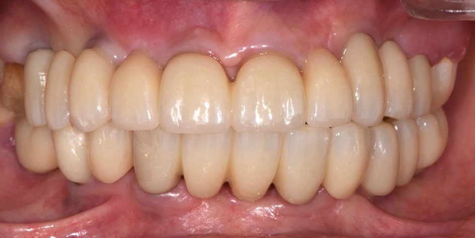 Il restauro definitivo alla consegna 5