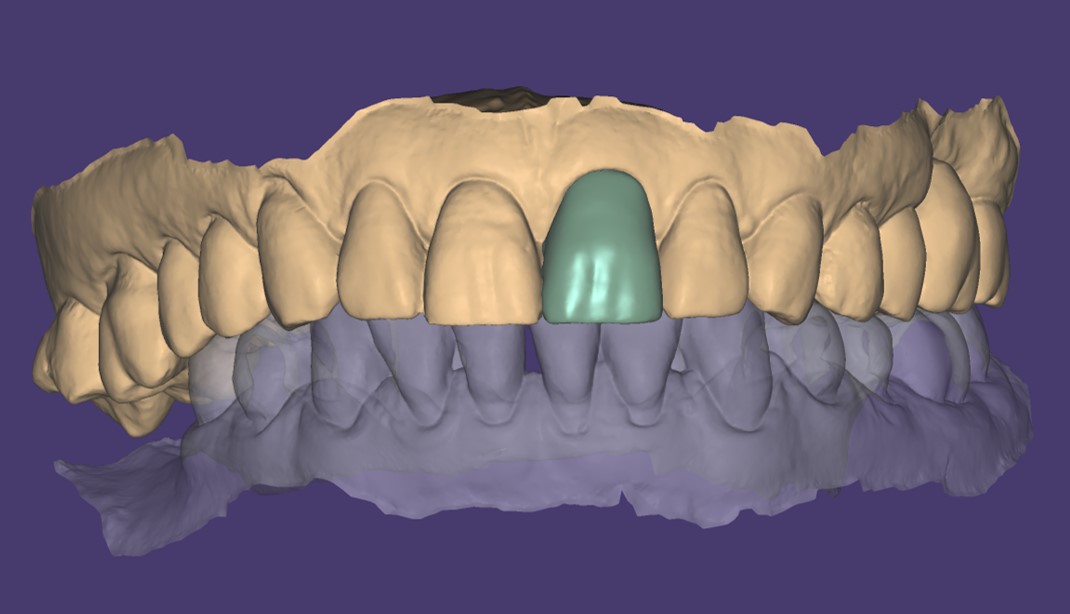 modellazione nuova faccetta