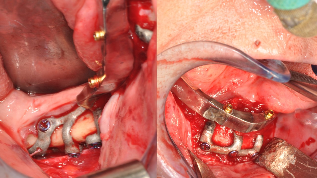 Controllo intraoperatorio del fit