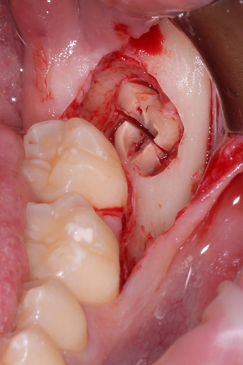 Divisione radicolare con inserto piezoelettrico