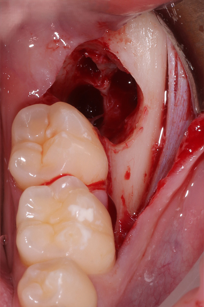 Alveolo post-estrattivo