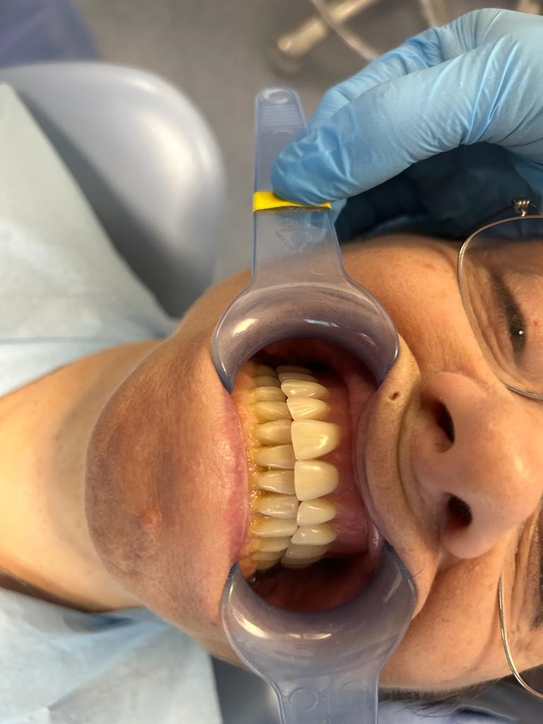 La protesi overdenture 