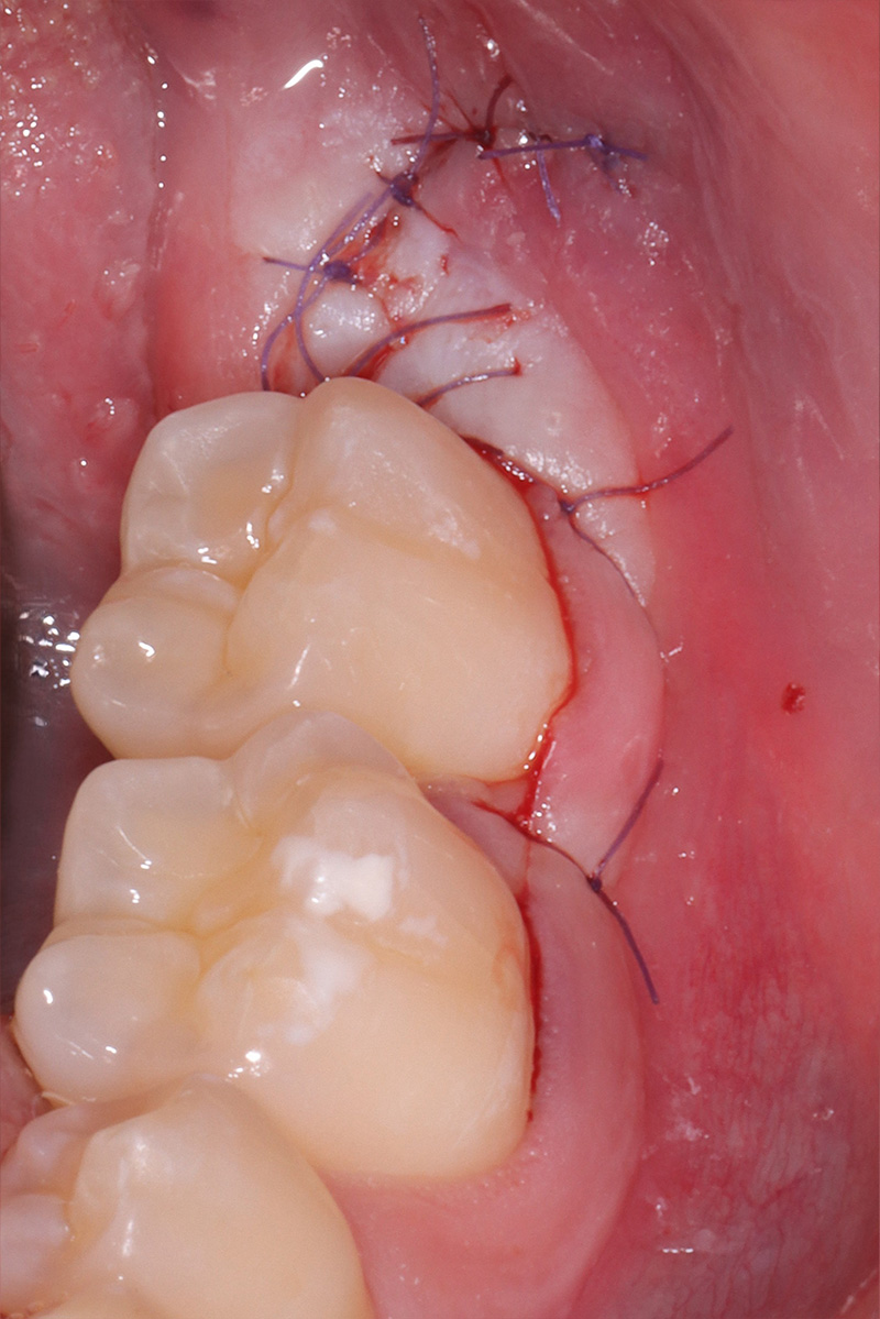 Sutura per prima intenzione