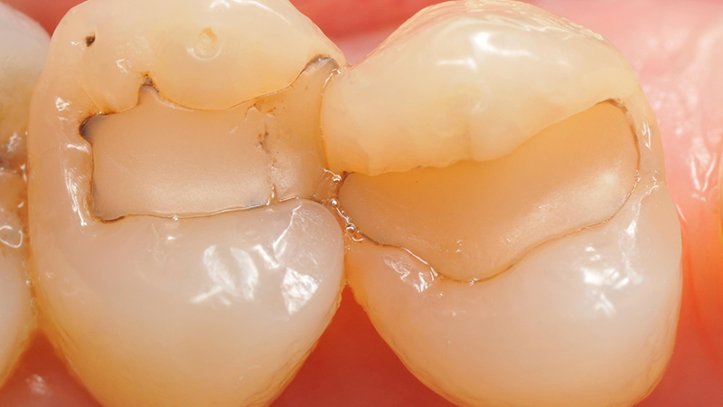 Situazione iniziale dei restauri, vecchi e infiltrati