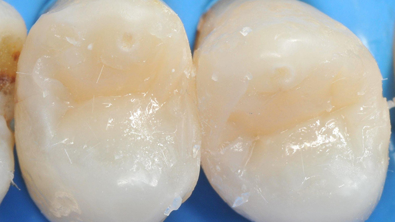 Tracciamento delle linee essenziali di ogni premolare in base all'anatomia del dente