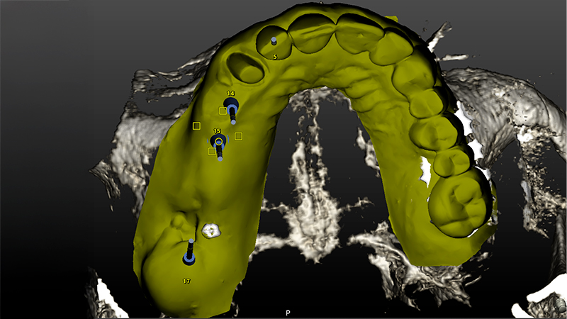 Pianificazione chirurgica della posizione implantare su Software Navident