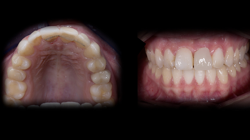 Risultato estetico del primo step