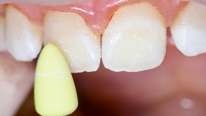 lucidatura del dente con gommino