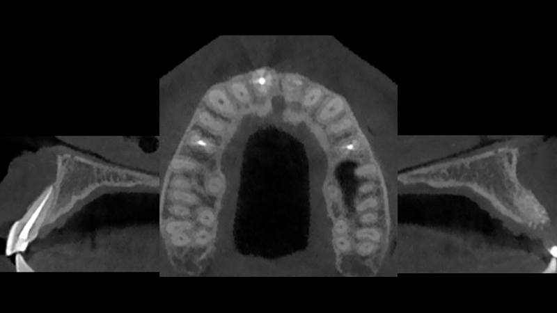 CBCT dopo 5 mesi