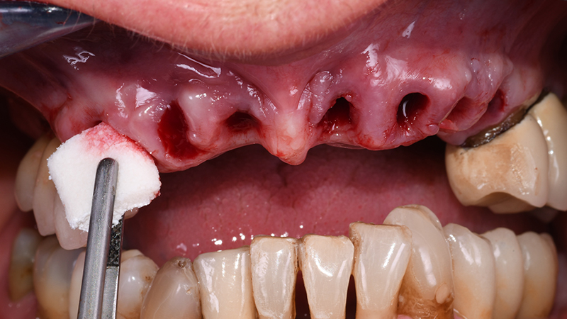 Applicazione di sostituto osseo collagenato