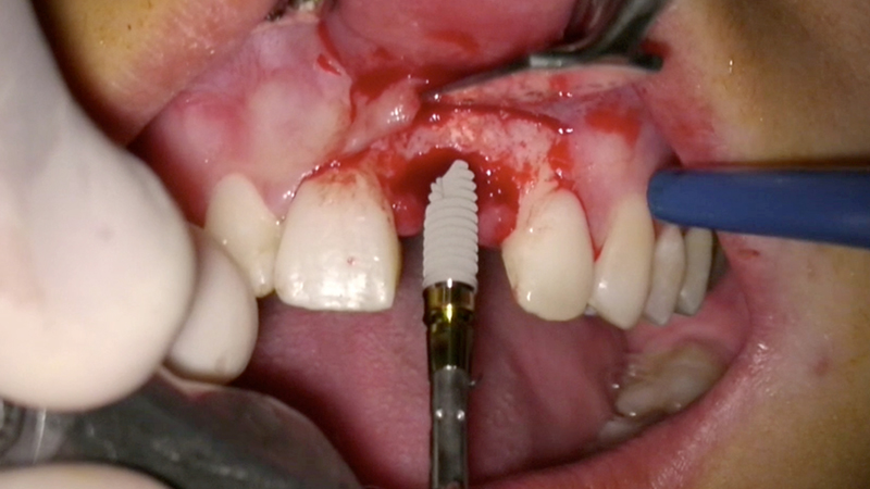 Posizionamento dell'impianto