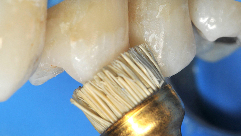 Lucidatura dei restauri con lo spazzolino Occlubrush