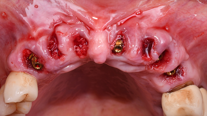 Visione occlusale dopo innesto osseo