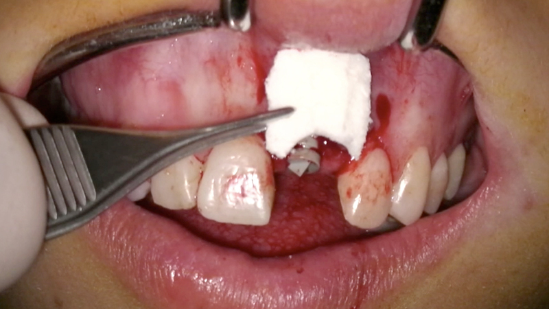 Posizionamento della matrice al microscopio