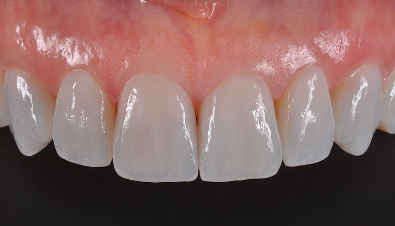 faccette arcata superiore