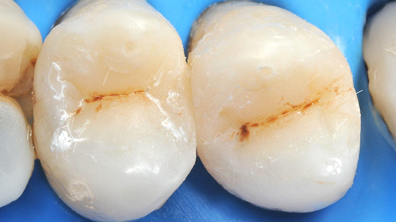 Aspetto finale dei restauri prima della rimozione della diga di gomma