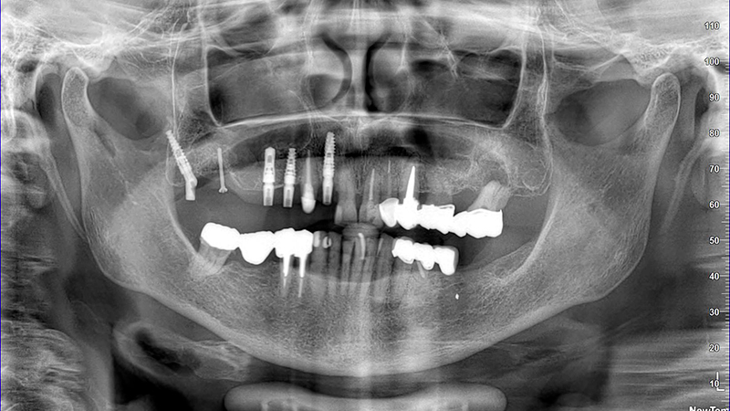 OPT con pterigoideo 17, rialzo trans-crestale 15 e Socket Shield su 12 e applicazione monconi per le conometrie protesiche parallele