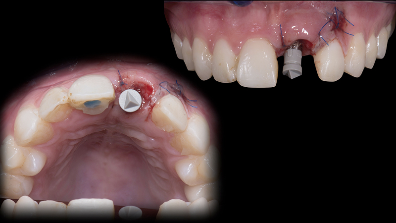 Sutura al microscopio