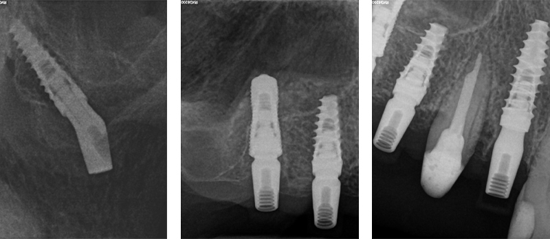 Fig.  16, 17, 18 - OPT con pterigoideo 17, rialzo trans-crestale 15 e Socket Shield su 12 e applicazione monconi per le conometrie protesiche parallele