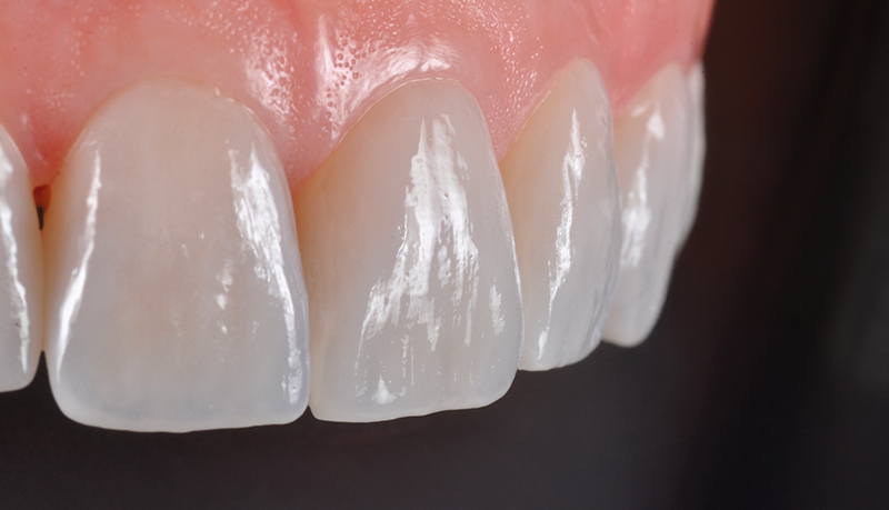 faccette arcata superiore