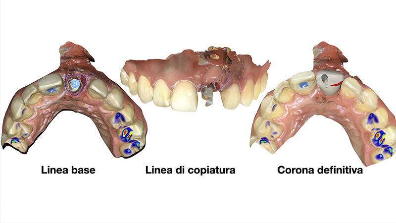 Pianificazioner digitale del secondo dente provvisorio avvitato sull'impianto