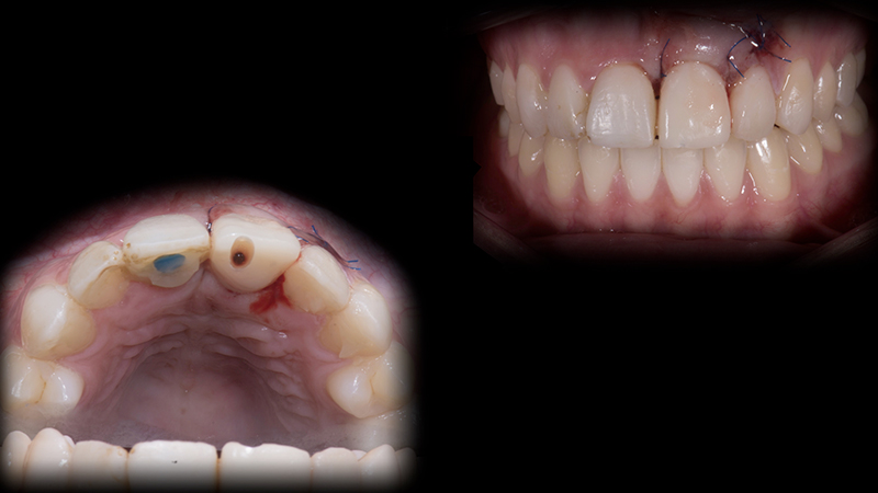 Secondo dente provvisorio avvitato