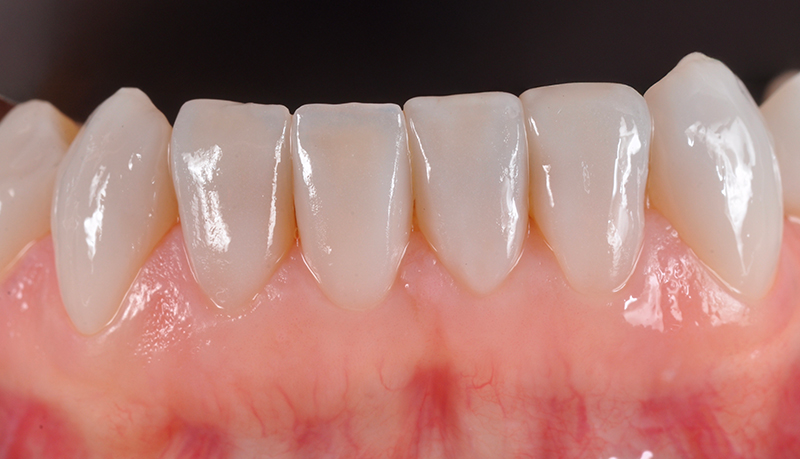 faccette arcata inferiore