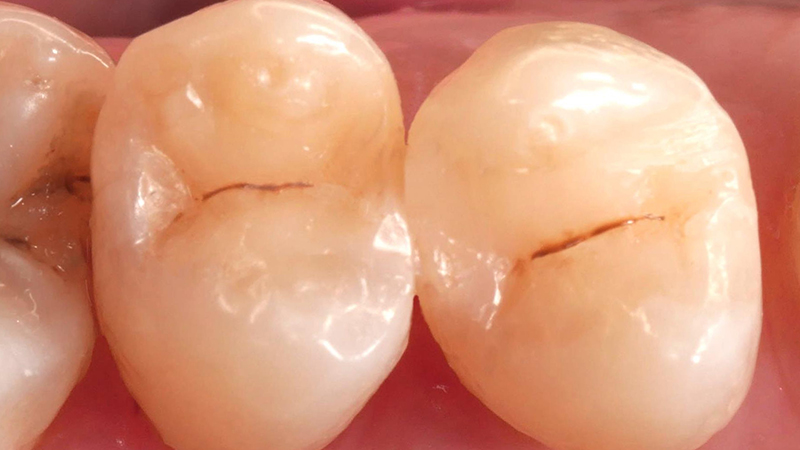 Aspetto finale dopo il follow-up ad un mese di distanza