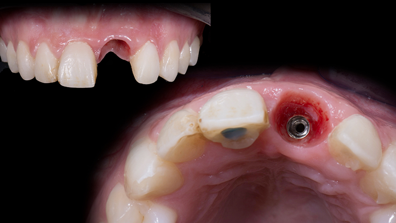 Aspetto dei tessuti molli dopo la rimozione del provvisorio