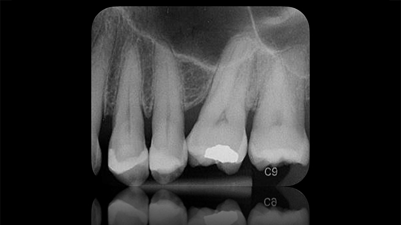 radiografia dopo il follow-up ad un mese di distanza