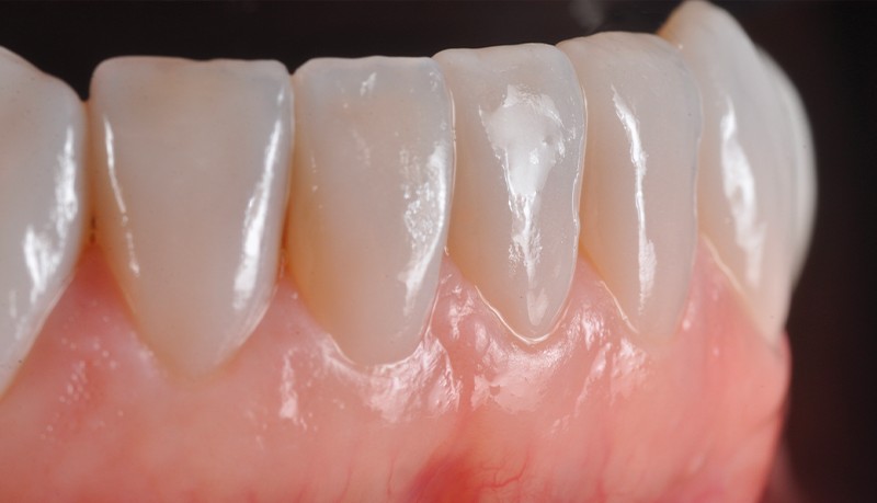 faccette arcata inferiore