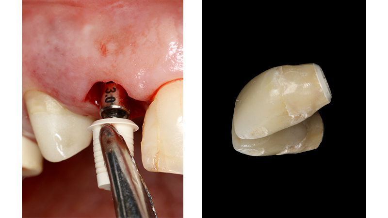 Carico immediato su 12 con moncone conometrico dritto e cappetta provvisoria in peek ribasata in resina su provvisorio. Foto dopo l'intervento con esecuzione flapless e leggera plastica gengivale del Tuber applicazione di cappette di guarigione in peek. Guarigione dei tessuti dopo 3 mesi e impronta digitale definitiva per finalizzare il caso