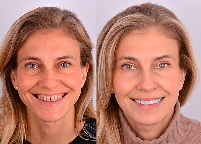 Integrazione della riabilitazione con faccette