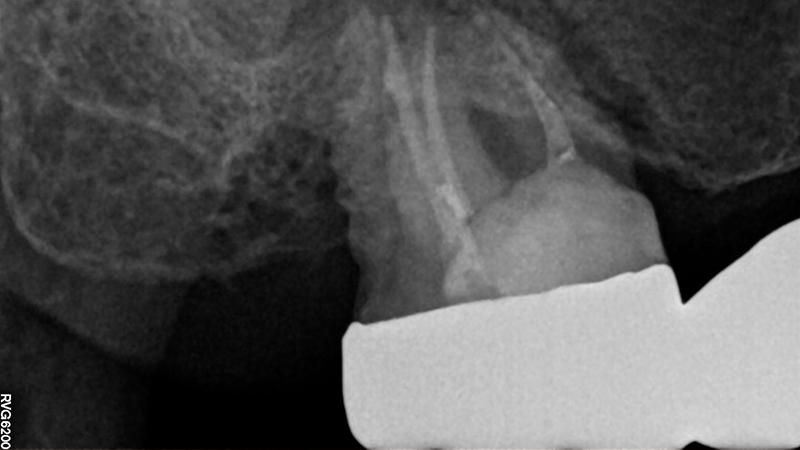Radiografia iniziale 