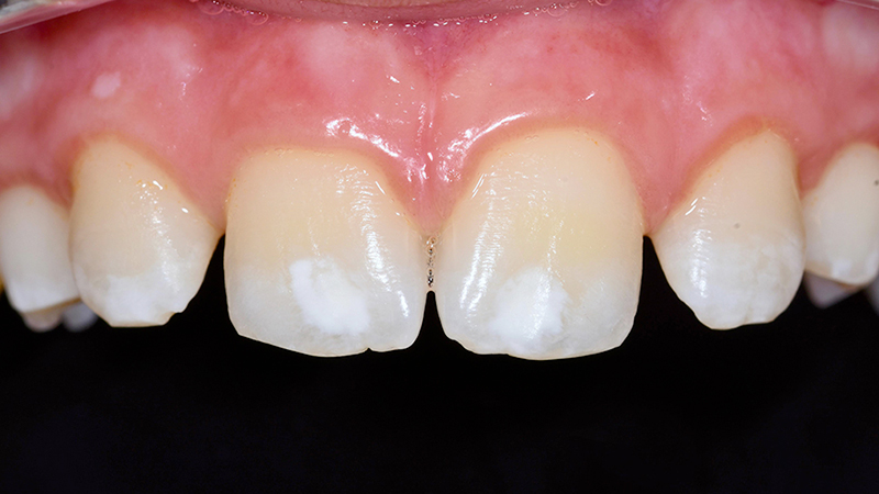 situazione iniziale: discromie dentali evidenti