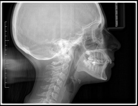 Teleradiografia latero-laterale pre-trattamento